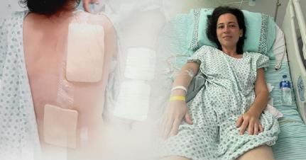 Após 20 anos de espera, paciente realiza 1ª supermicrocirurgia para transplante de linfonodo na Bahia